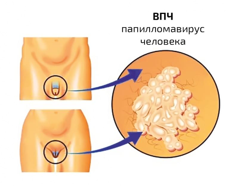 HPV detectie tipuri cu risc crescut + genotipare extinsa