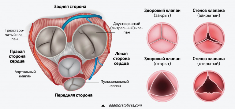 Схема пороков сердца: дефекты межпредсердной перегородки, межжелудочной перегородки, тетрада Фалло, Декстро-транспозиция магистральных артерий, стенозы клапана