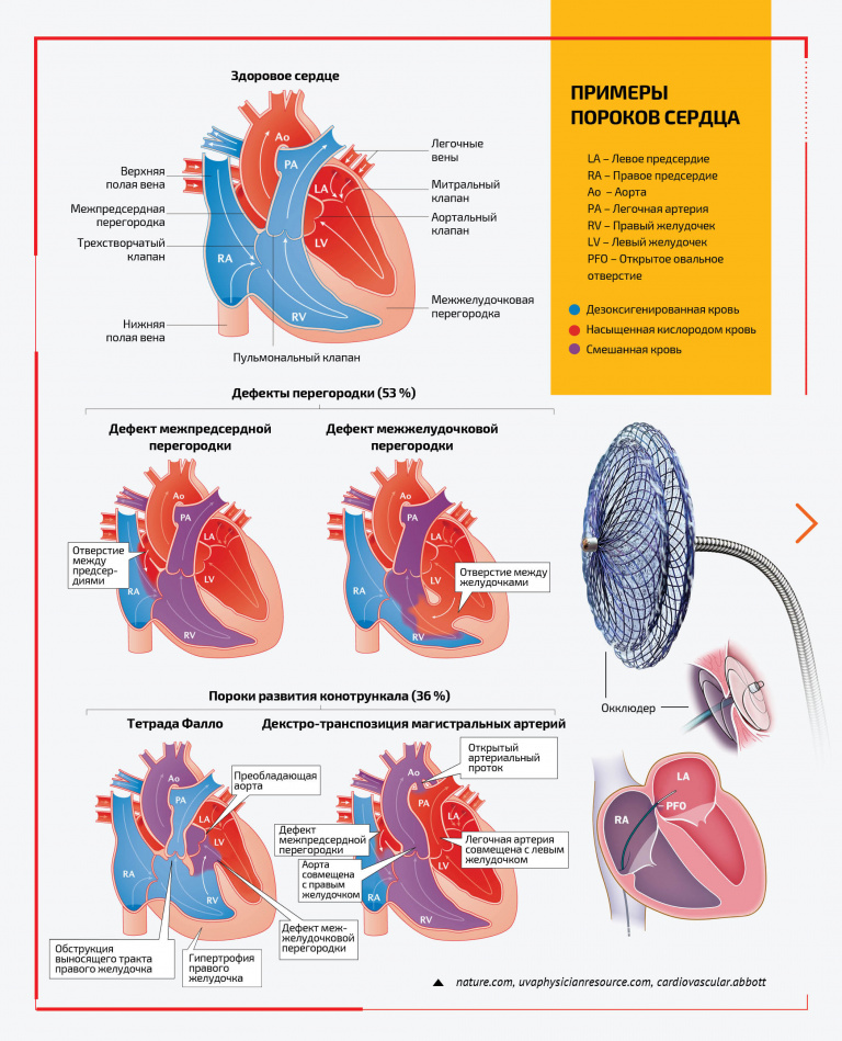 Есть и другие пороки: неправильное положение сердца, единственный желудочек, стеноз аорты