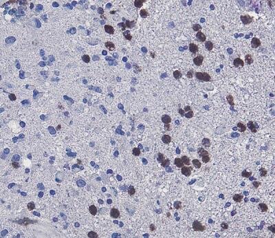 Лейкоциты могут убивать опухолевые клетки. Но это плохая новость. 