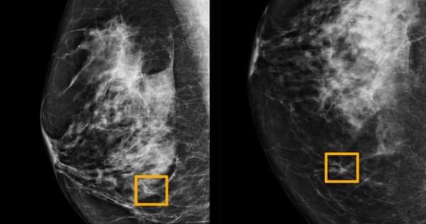 Новый ИИ от Google обнаруживает рак молочной железы, сканируя рентген 