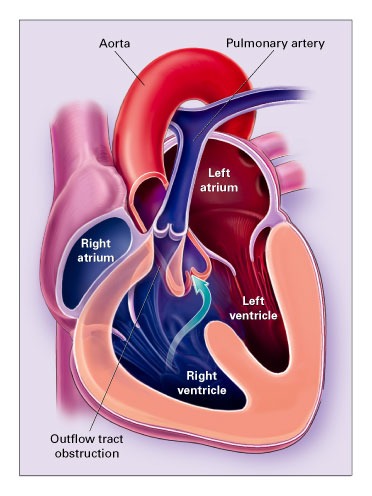 Схема врождённого порока сердца
