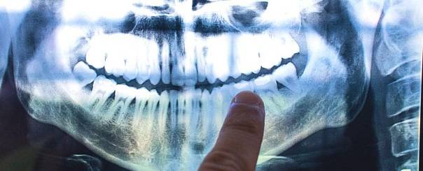 Зубы могут «записывать» определенные жизненные события