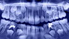 В Индии стоматологи вытащили более 500 зубов изо рта семилетнего мальчика 