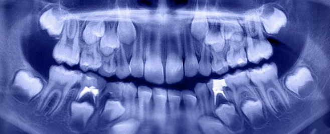 В Индии стоматологи вытащили более 500 зубов изо рта семилетнего мальчика 