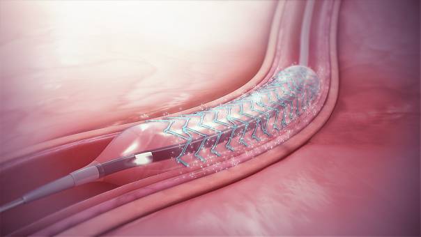 Трехмерная модель поможет спрогнозировать рецидивы ишемии сердца после установки стента