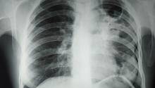 ИИ оказался эффективным инструментом по борьбе с туберкулёзом