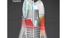 Инновационные зубные имплантаты защищаются от бактерий и генерируют электричество