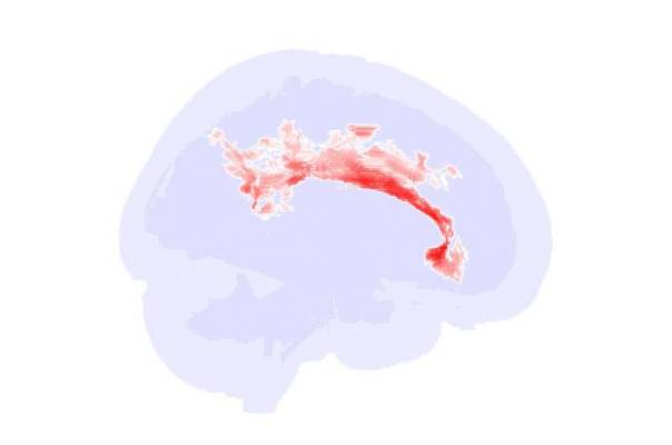 Расстройства аутистического спектра меняют структуру белого вещества мозга