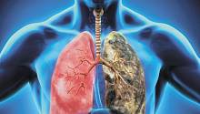 Выделены новые подтипы рака лёгких у некурящих