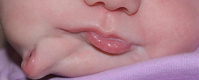 Из-за редкого заболевания ребенок родился со вторым ртом