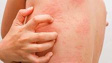Люди с хронической болезнью почек чаще имеют воспалительные заболевания кожи