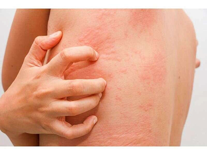 Люди с хронической болезнью почек чаще имеют воспалительные заболевания кожи