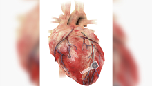 Новый временный кардиостимулятор растворяется в организме после использования