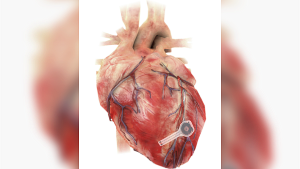 Новый временный кардиостимулятор растворяется в организме после использования