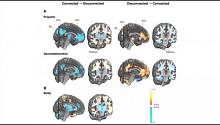 Найдены участки мозга, отвечающие за изменения состояний сознания