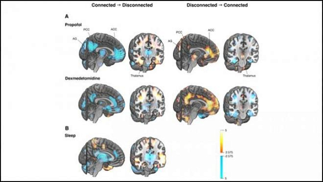 Найдены участки мозга, отвечающие за изменения состояний сознания