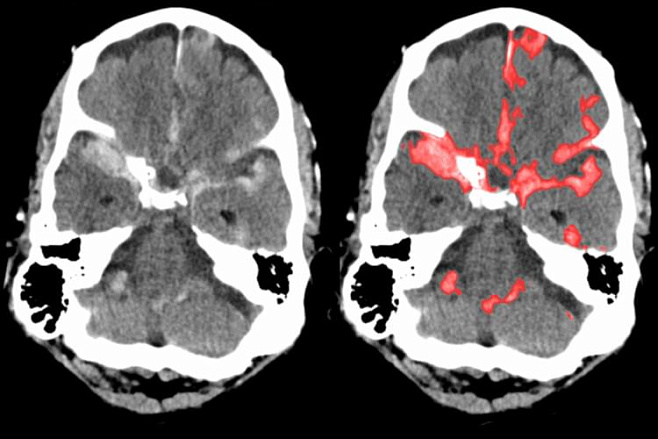 Новый алгоритм ИИ обучили выявлять кровоизлияния в мозг