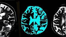 Первое наблюдение белковых скоплений в мозге людей с болезнью Альцгеймера