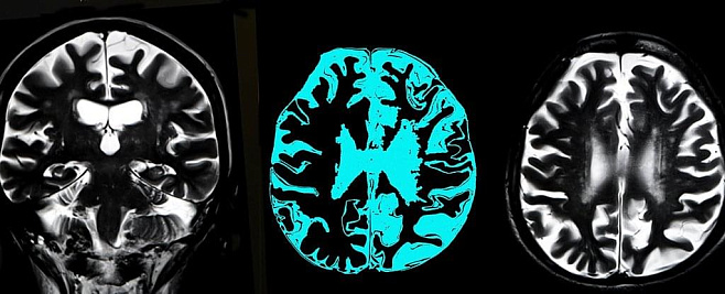 Первое наблюдение белковых скоплений в мозге людей с болезнью Альцгеймера