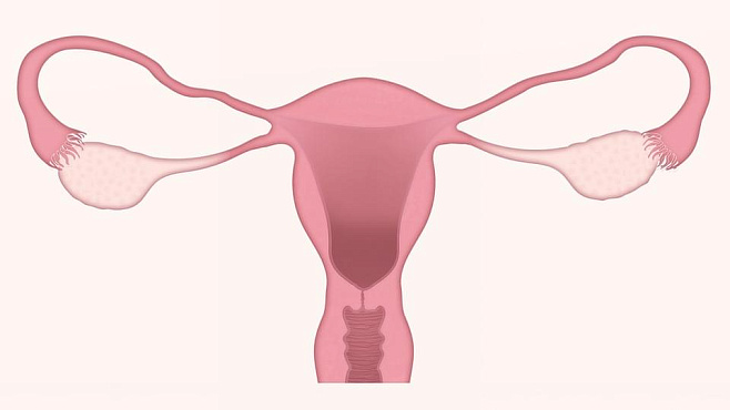 Препарат для снижения выработки гормонов может уменьшить тяжелые менструальные кровотечения