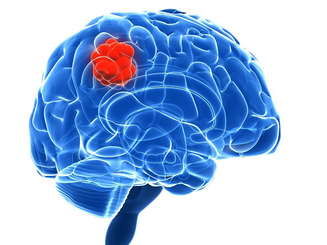 Ученые обнаружили, как опухоль головного мозга влияет на функции полезных клеток