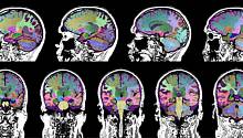 МРТ отличает потерю памяти при болезни Альцгеймера и черепно-мозговой травме