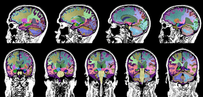 МРТ отличает потерю памяти при болезни Альцгеймера и черепно-мозговой травме