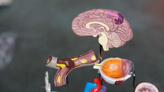 Нейросеть сможет распознать аневризмы на снимках мозга