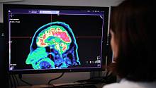 Ученые нашли связь между биполярным расстройством и нейровоспалением