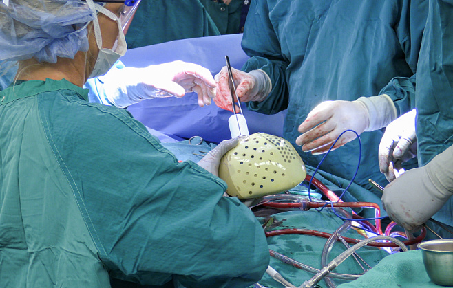 В США провели первую имплантацию полностью искусственного сердца человеку
