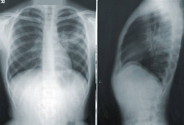 Белгородская нейросеть выявит коронавирус по рентгеновским снимкам