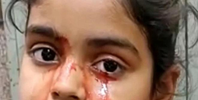 Девочка озадачила врачей кровавыми слезами