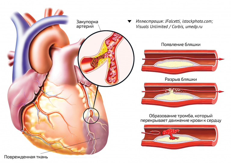 Тромбоз коронарной артерии. Сколько стоит тромба