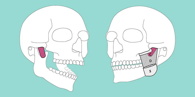 Идентифицирован новый мышечный слой в челюсти человека 