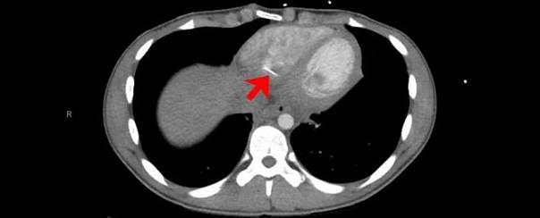 В сердце подростка нашли булавку 