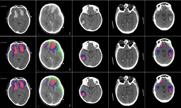 Разработан алгоритм, типологизирующий повреждения мозга