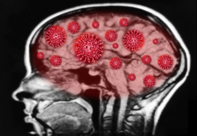 Мозг пациентов, умерших от COVID-19, обладает признаками болезни Паркинсона