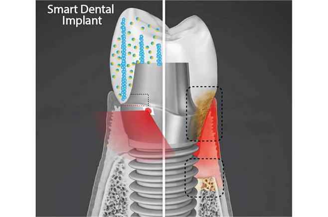 Инновационные зубные имплантаты защищаются от бактерий и генерируют электричество
