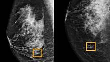 Новый ИИ от Google обнаруживает рак молочной железы, сканируя рентген 