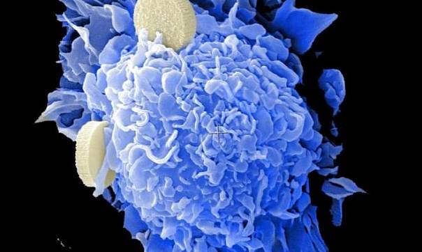 Создан новый тест, способный быстро диагностировать рак яичников