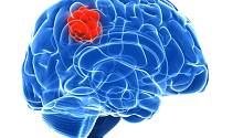Ученые обнаружили, как опухоль головного мозга влияет на функции полезных клеток