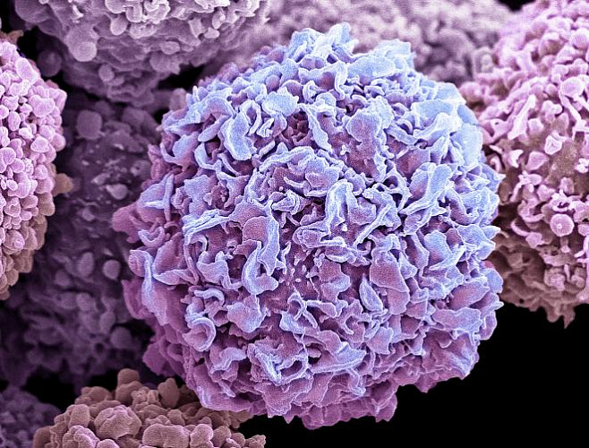 Обнаружен ген, ответственный за появление одной из тяжелейших форм рака груди