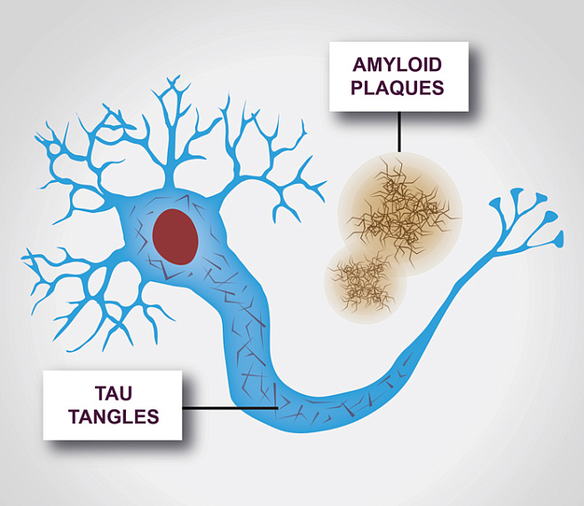Хиральность тау-белков связана с развитием болезни Альцгеймера